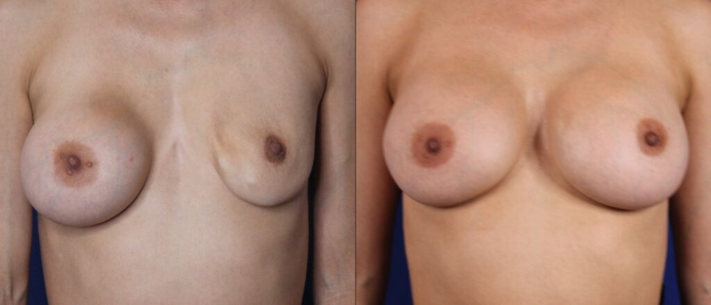 Breast Revision result &mdash; Patient 6