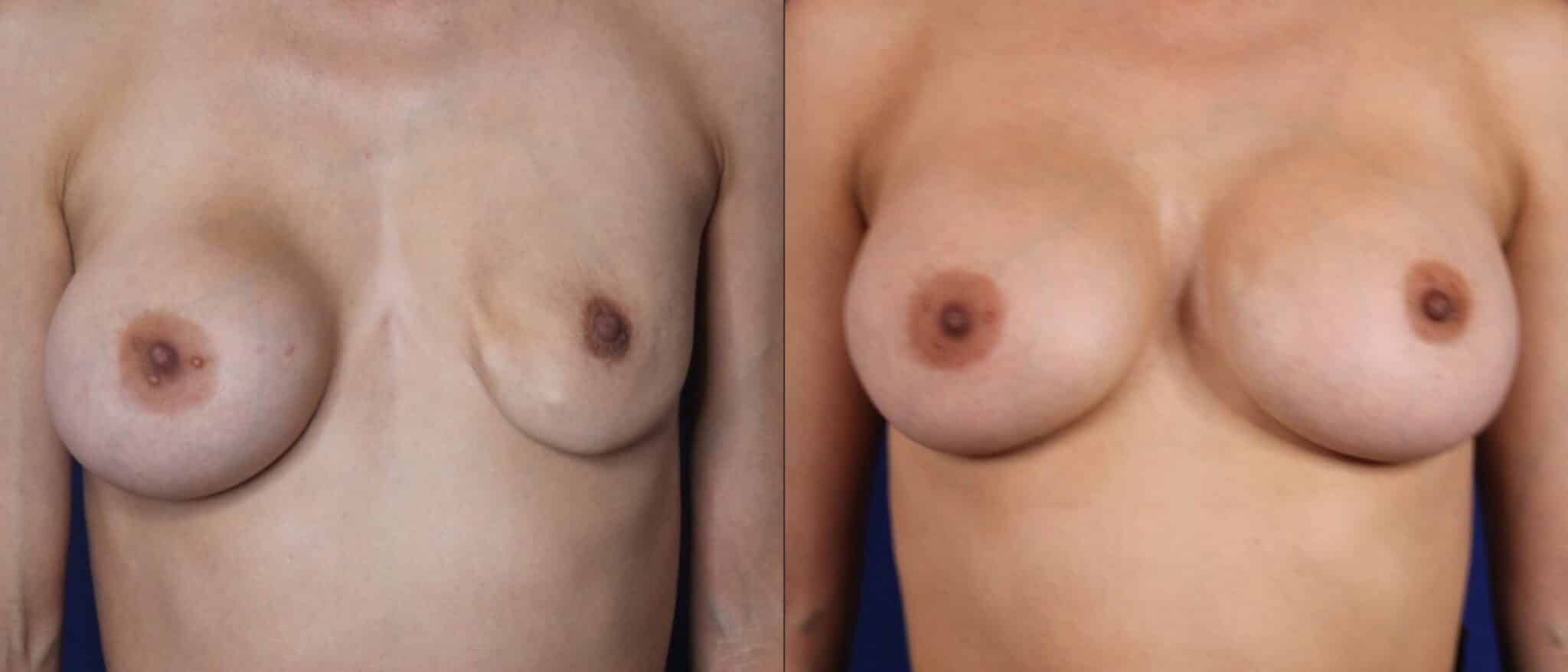 Breast Reduction result &mdash; Patient 2