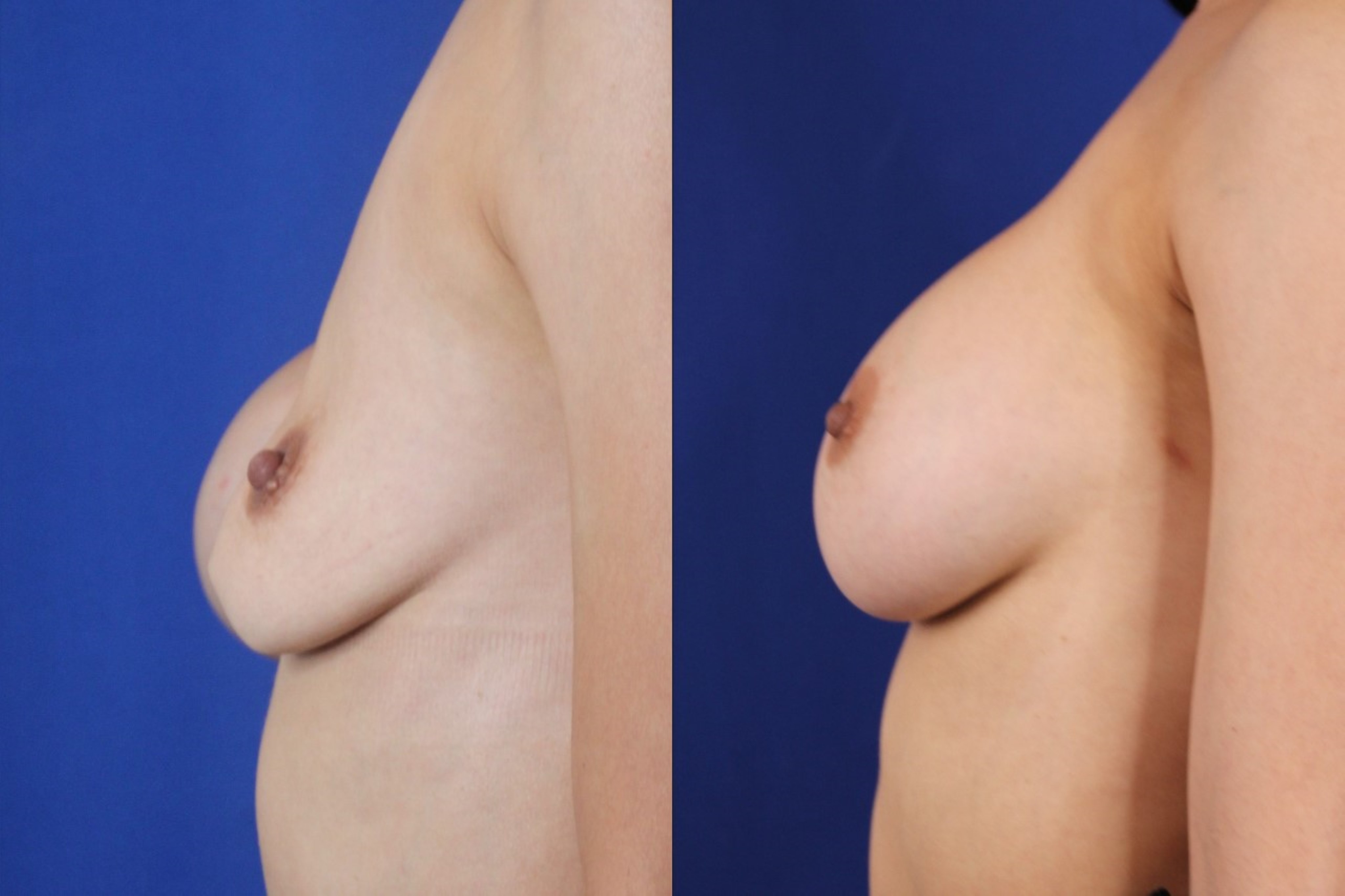 Breast Revision result &mdash; Patient 7