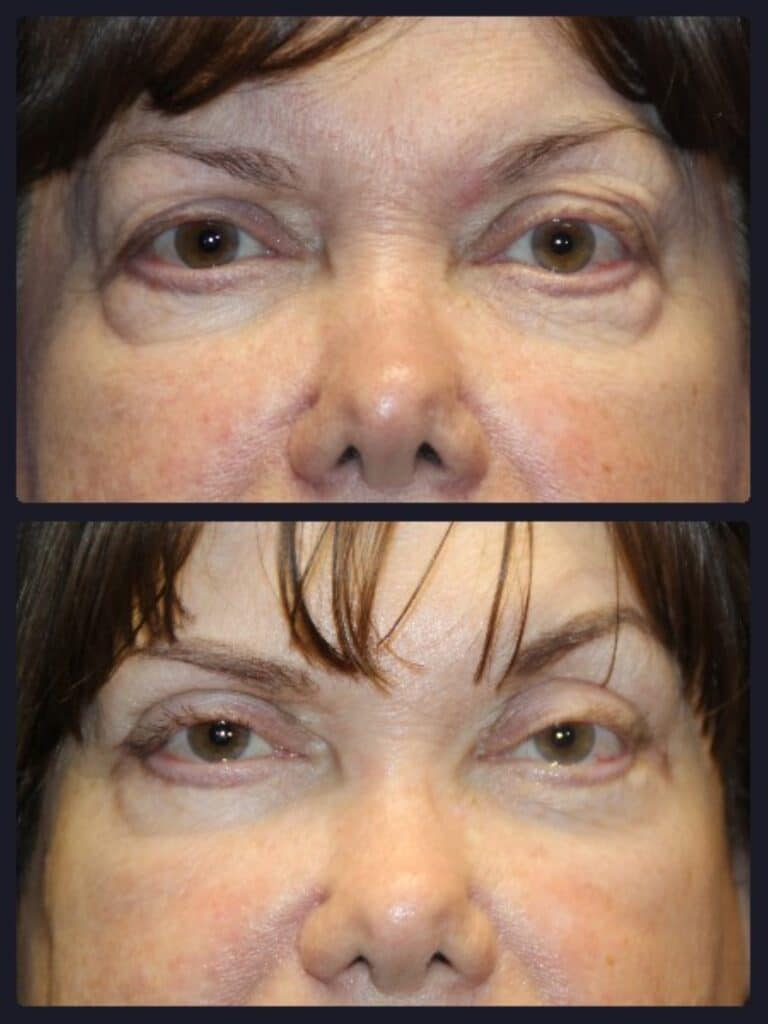 Eyelid rejuvenation before and after &mdash; Patient 9, front view