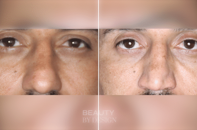 Rhinoplasty front view &mdash; Patient 4 &mdash; Male Rhinoplasty