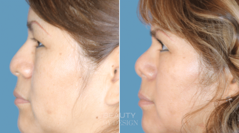 Rhinoplasty side profile &mdash; Patient 3 &mdash; Natural Nose Reshaping
