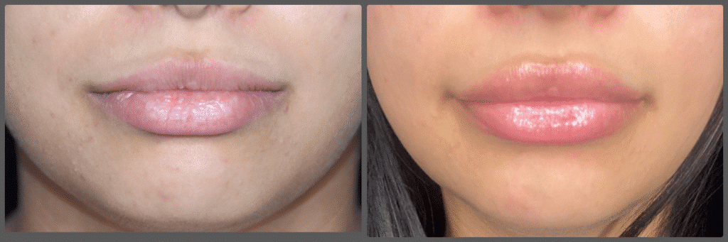 Lip Augmentation result &mdash; Patient 3