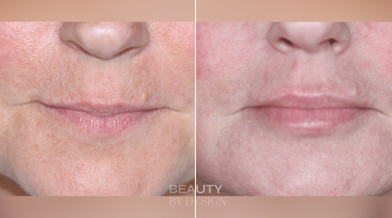Lip Augmentation result &mdash; Patient 4