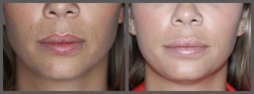 Lip Augmentation result &mdash; Patient 6