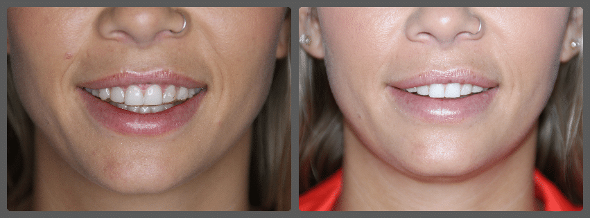 Lip Augmentation result &mdash; Patient 7