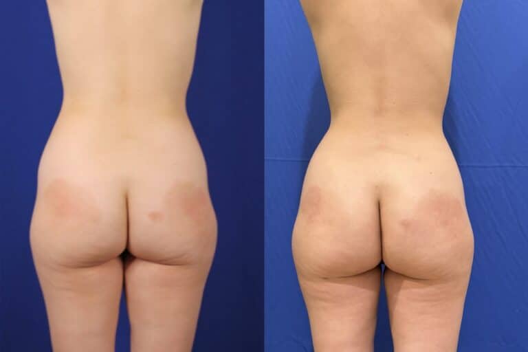 Glute enhancement before and after &mdash; Patient 3
