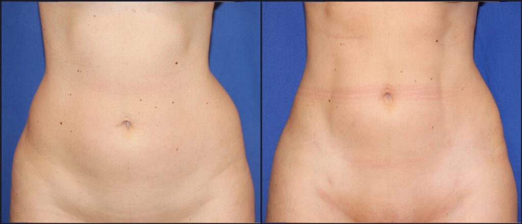 Body Contouring result &mdash; Patient 9