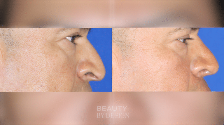 Rhinoplasty side profile &mdash; Patient 7 &mdash; Male Profile Rhinoplasty