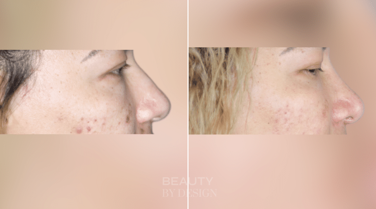 Rhinoplasty side profile &mdash; Patient 5 &mdash; Revision Rhinoplasty