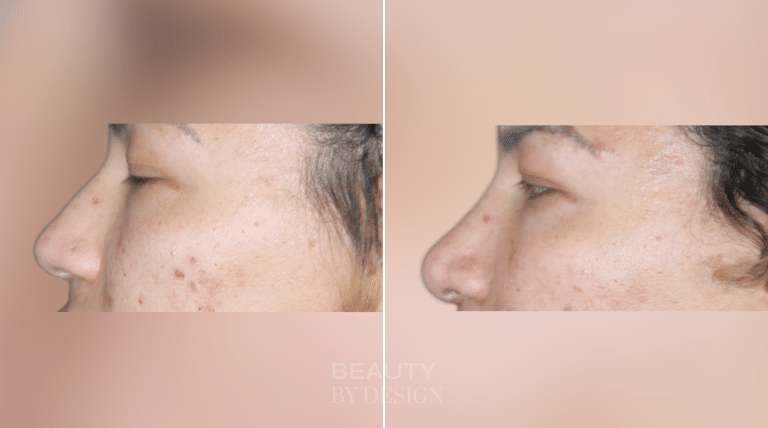 Rhinoplasty side profile &mdash; Patient 5 &mdash; Revision Rhinoplasty