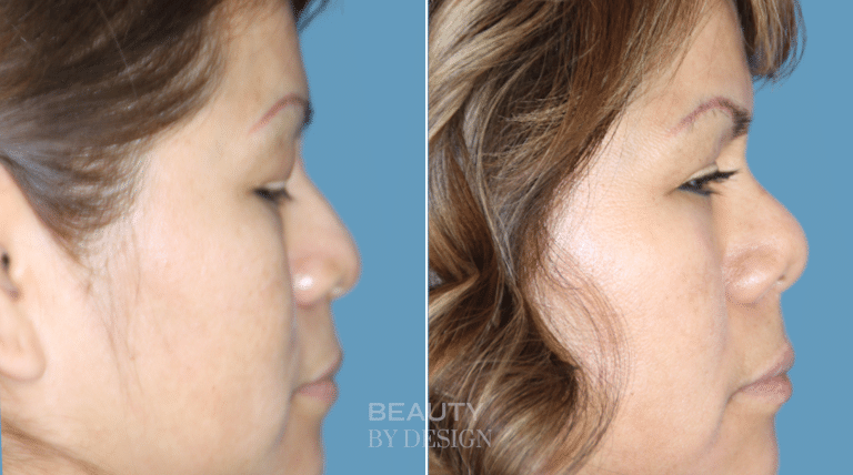 Rhinoplasty side profile &mdash; Patient 3 &mdash; Natural Nose Reshaping