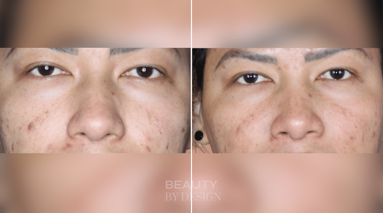 Rhinoplasty before & after &mdash; Patient 5 &mdash; Revision Rhinoplasty