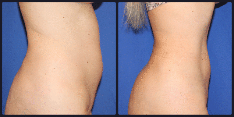 Body Contouring result &mdash; Patient 10