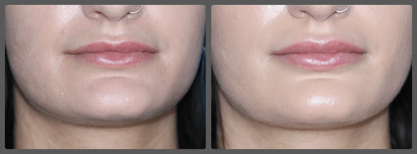 Lip Augmentation result &mdash; Patient 5