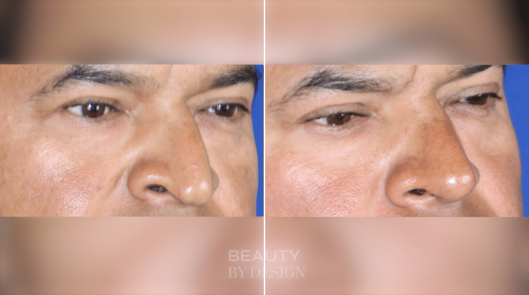 Rhinoplasty three-quarter view &mdash; Patient 7 &mdash; Male Profile Rhinoplasty