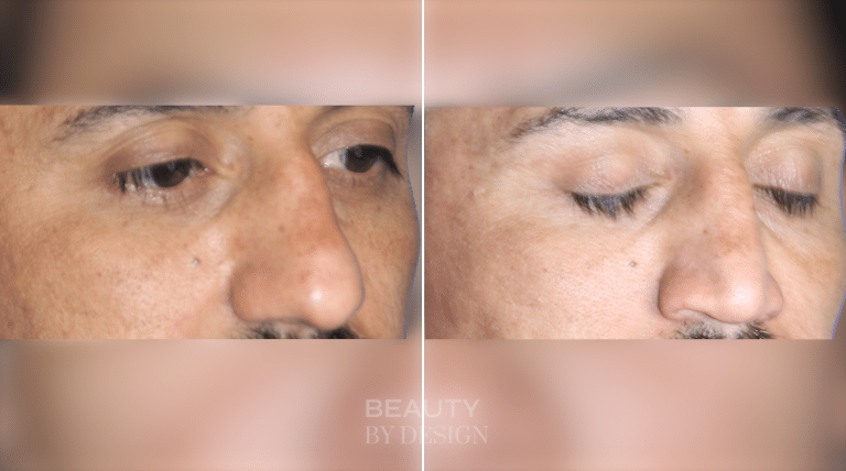 Rhinoplasty three-quarter view &mdash; Patient 4 &mdash; Male Rhinoplasty