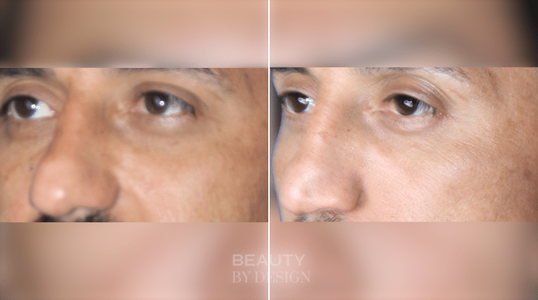 Rhinoplasty three-quarter view &mdash; Patient 4 &mdash; Male Rhinoplasty