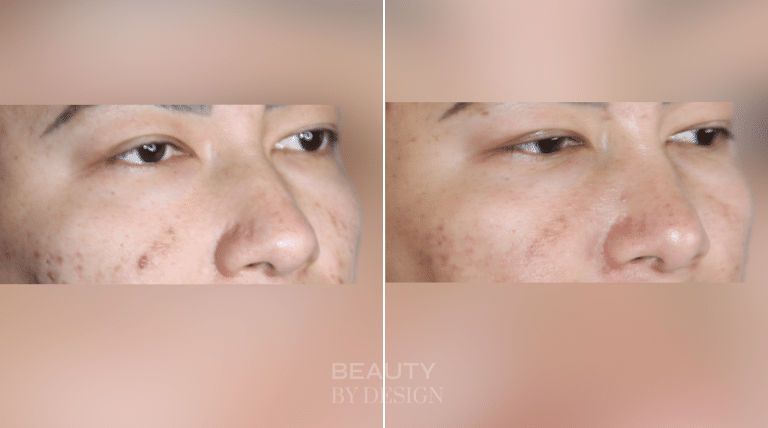 Rhinoplasty three-quarter view &mdash; Patient 5 &mdash; Revision Rhinoplasty