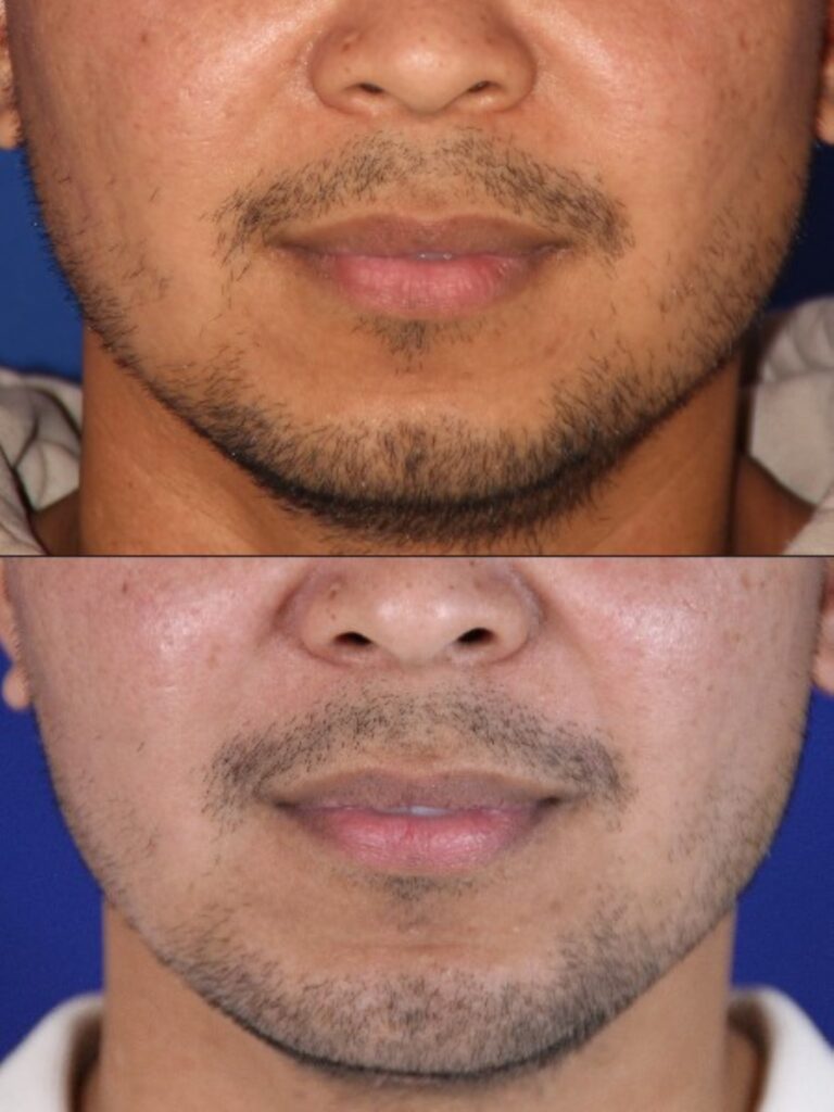 Submental liposuction before and after &mdash; Patient 6