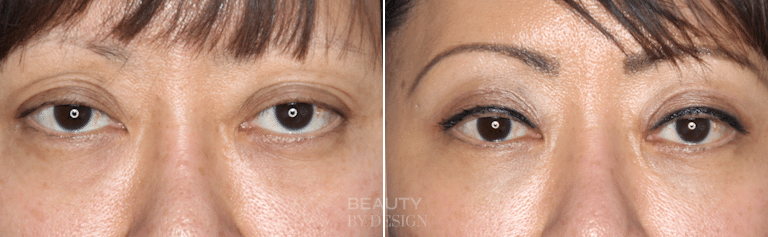 Upper and lower blepharoplasty before and after &mdash; Patient 5
