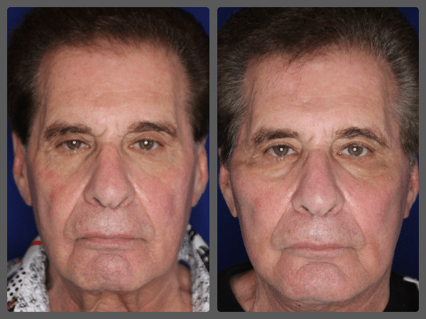 Genioplasty before and after &mdash; Patient 4