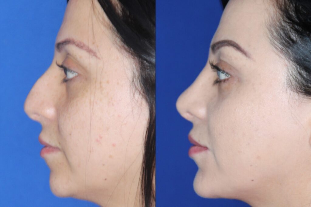 Rhinoplasty side profile &mdash; Patient 6 &mdash; Functional Rhinoplasty