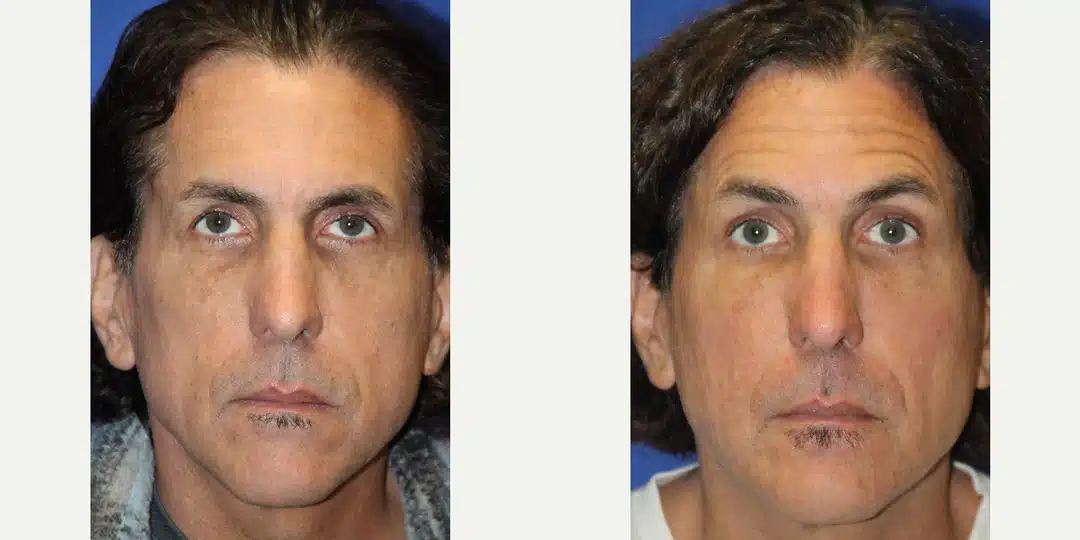 Facial fat transfer before and after &mdash; male facial rejuvenation
