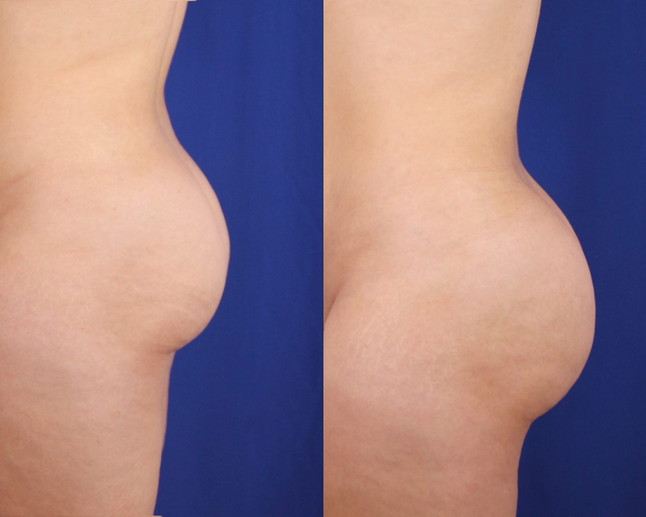 BBL before and after &mdash; side profile showing enhanced projection