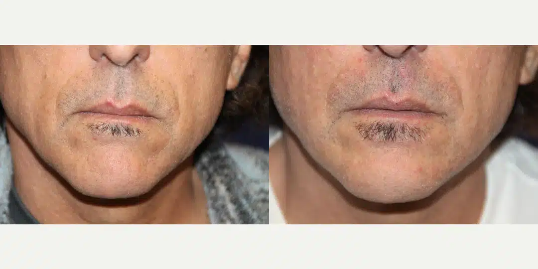 Facial fat transfer before and after &mdash; male chin and perioral region