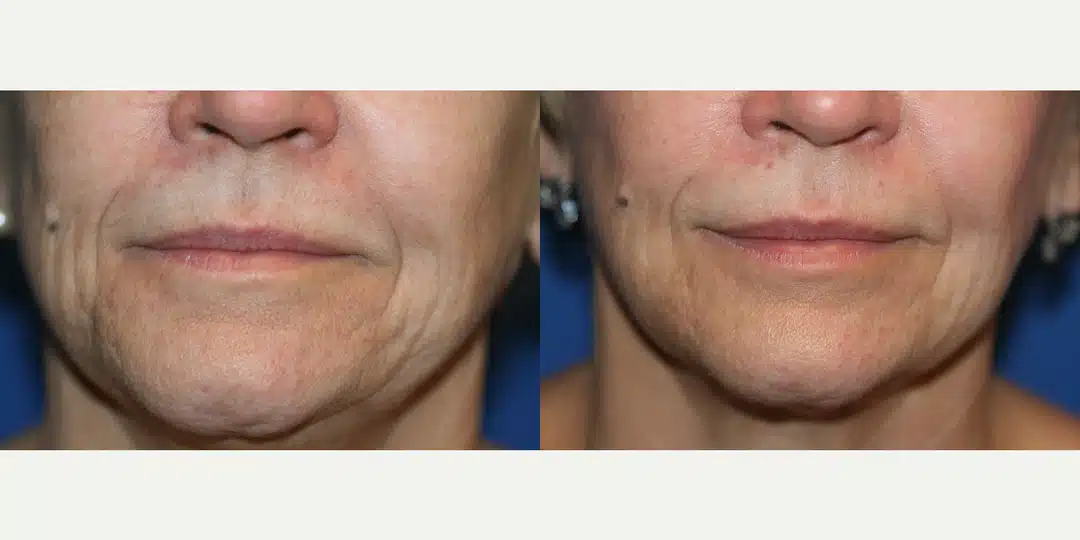 Facial fat transfer before and after &mdash; perioral lines smoothed