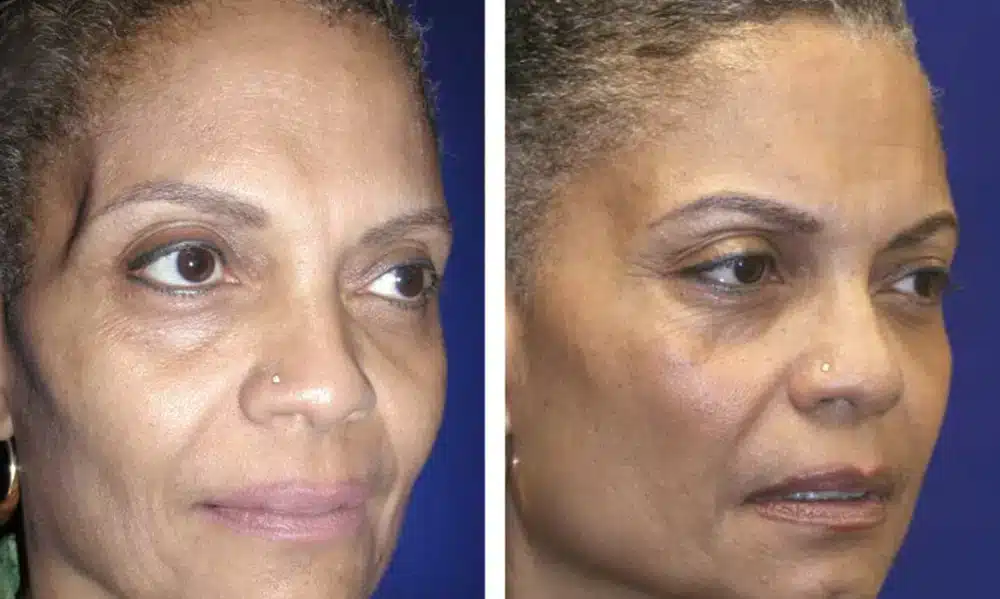Facial fat transfer before and after &mdash; upper midface and temple