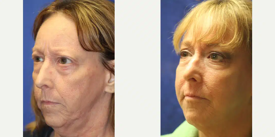 Facial fat transfer before and after &mdash; volume restoration