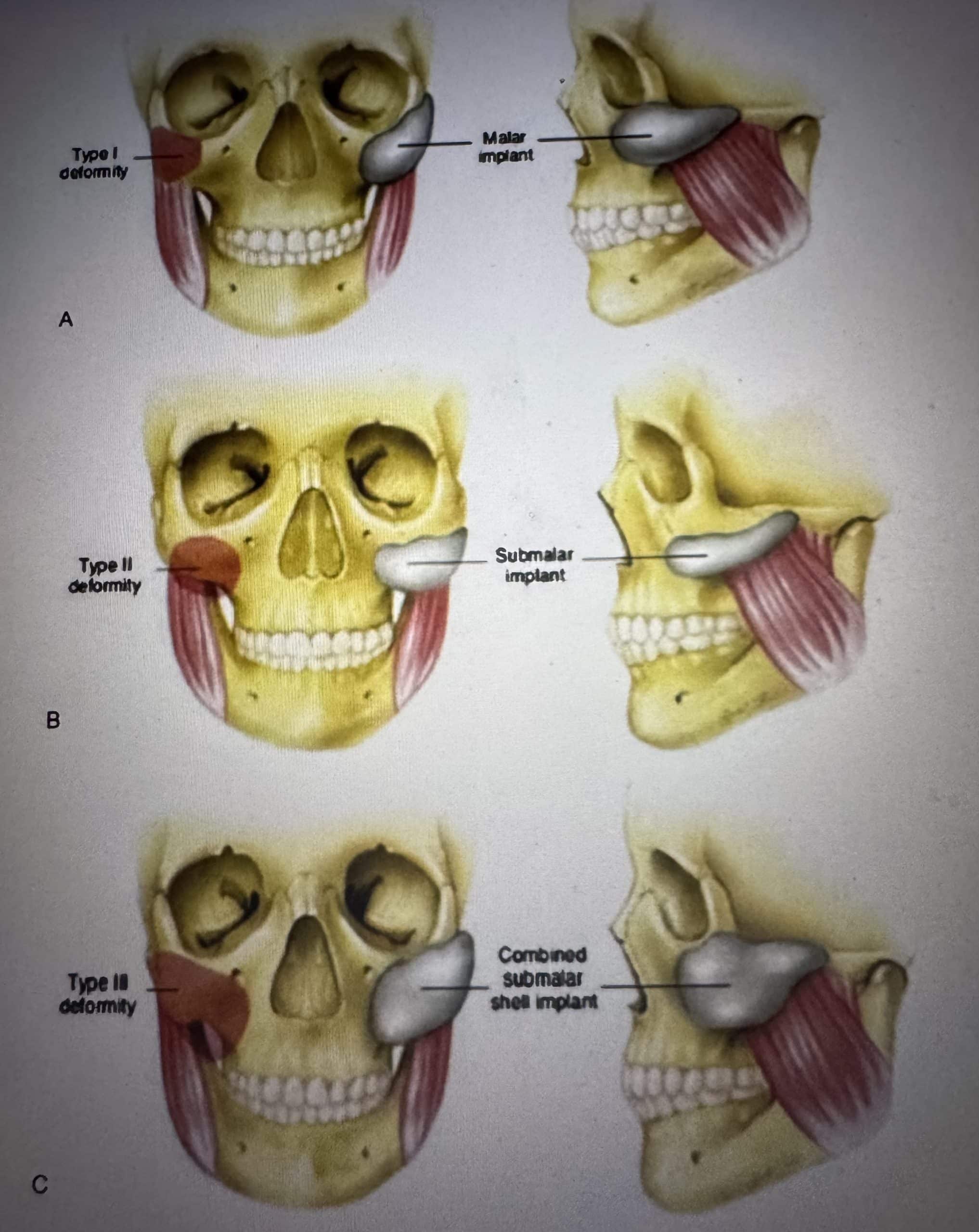 Skull illustration showing malar and submalar implant placement areas
