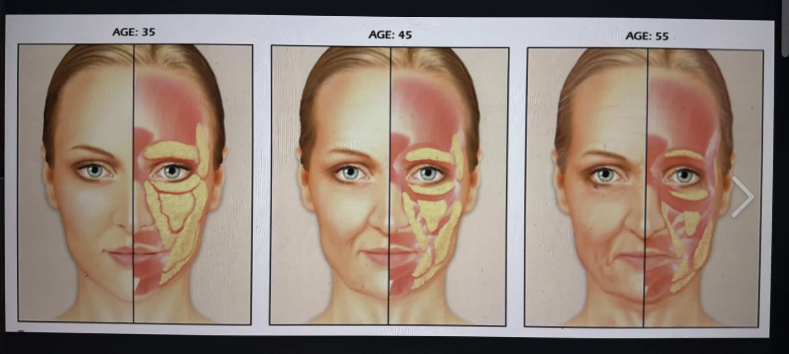 Illustration showing how facial fat and soft tissues change over time