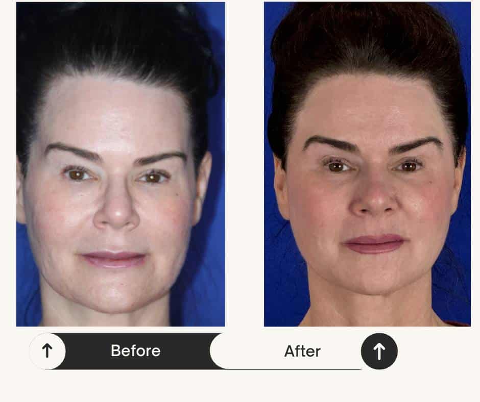 Front view example photo related to facial implant outcomes (educational). Individual results vary.