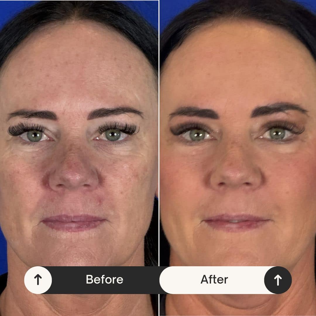 Before and after photos showing facial volume restoration in the midface area