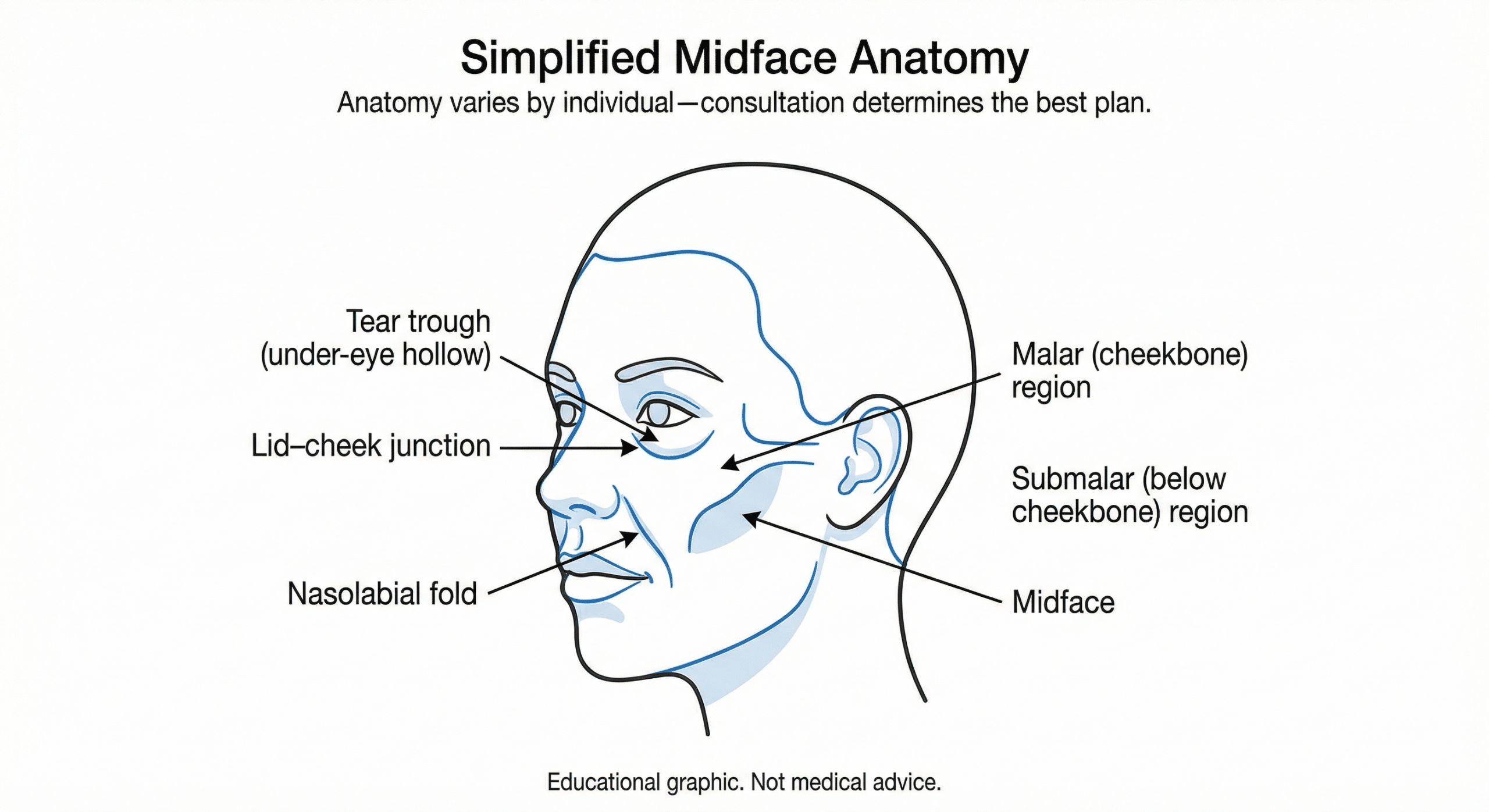 Diagram labeling malar and submalar cheek regions, lid-cheek junction, tear trough, and nasolabial fold