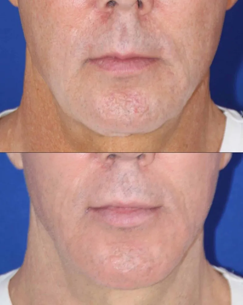 Chin augmentation before and after &mdash; real patient result
