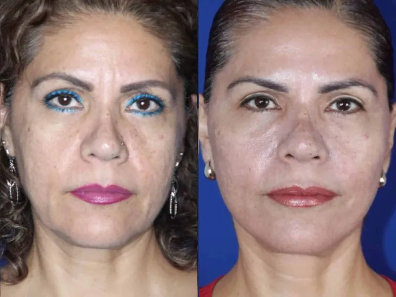 Facelift before and after &mdash; real patient result