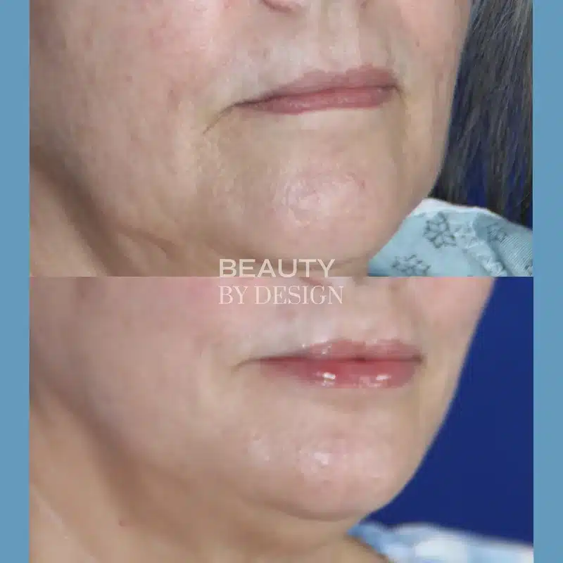 Bellafill before and after &mdash; oblique view, mature female patient with perioral rejuvenation