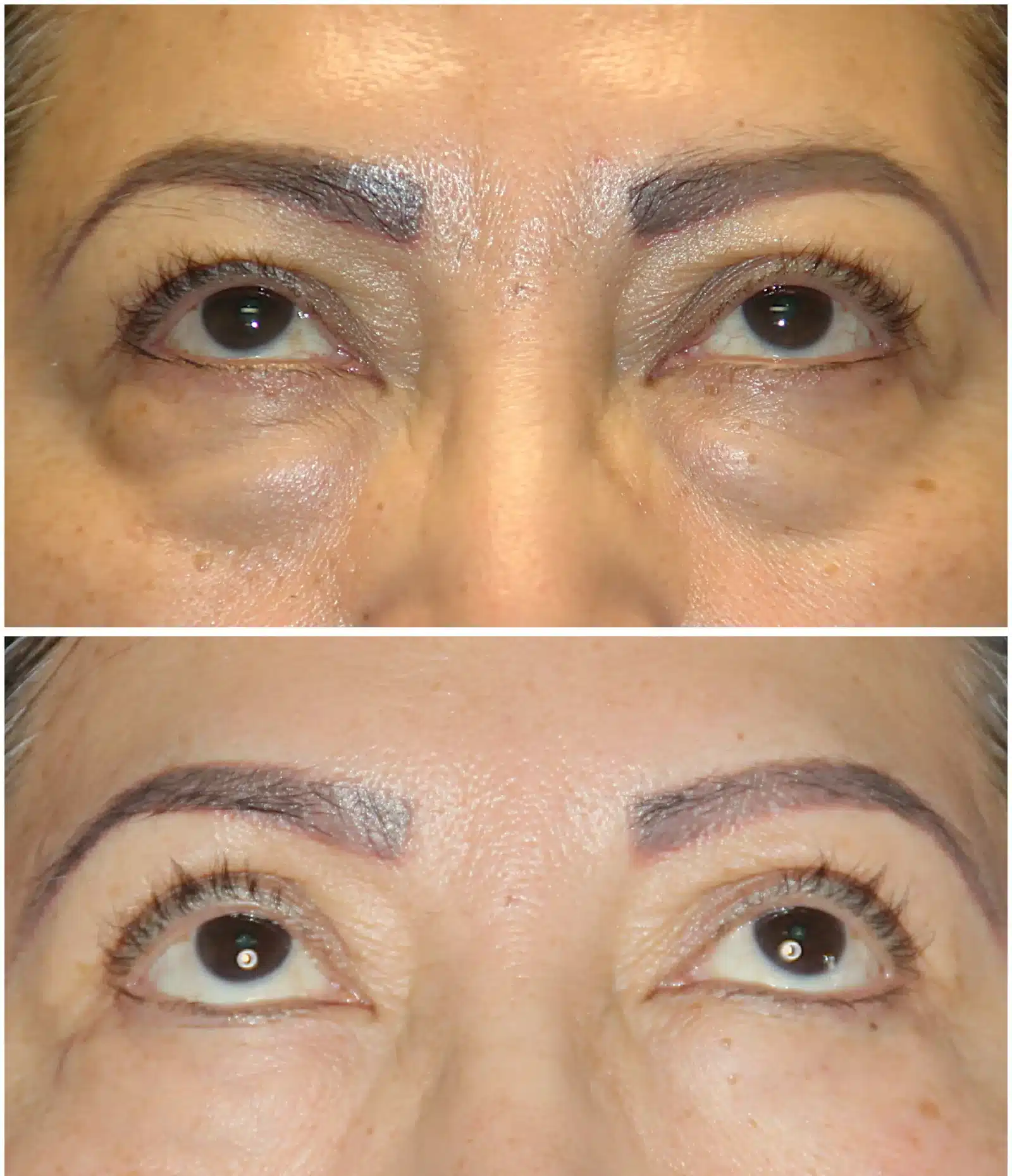Lower blepharoplasty before and after &mdash; Patient 13