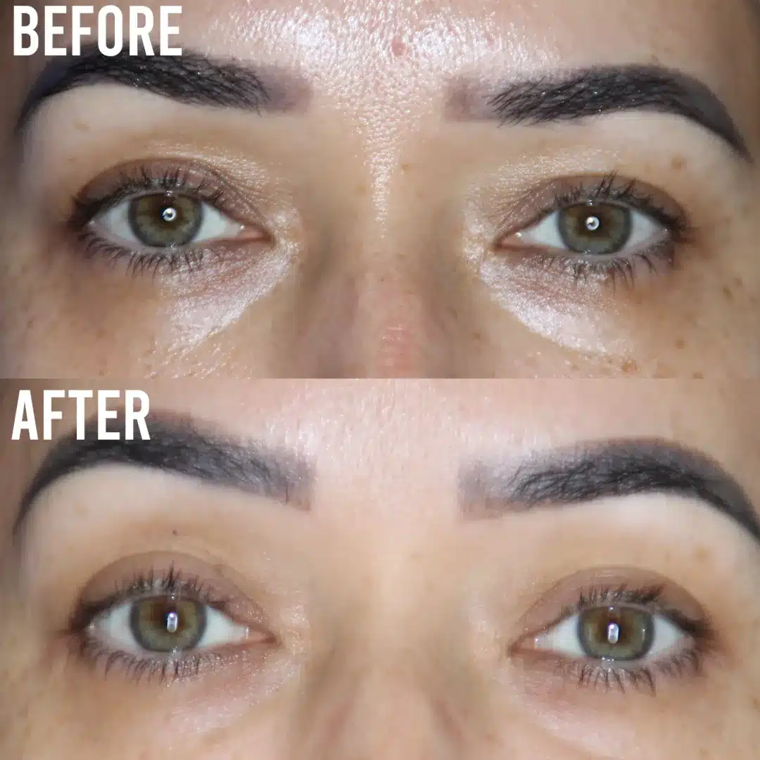 Upper blepharoplasty before and after &mdash; Patient 12