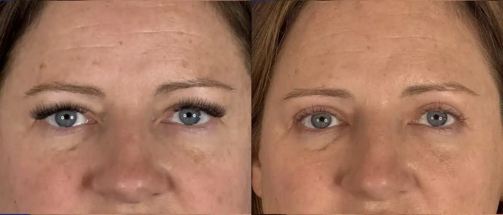 Upper blepharoplasty before and after &mdash; Patient 8