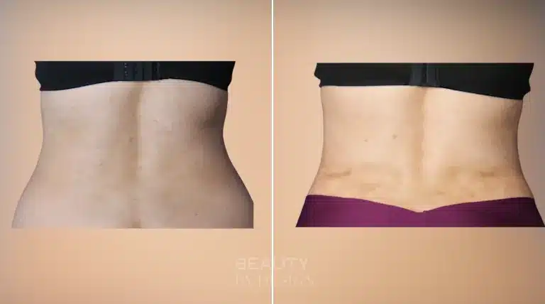 Liposuction body contouring before and after, rear view &mdash; Patient 3