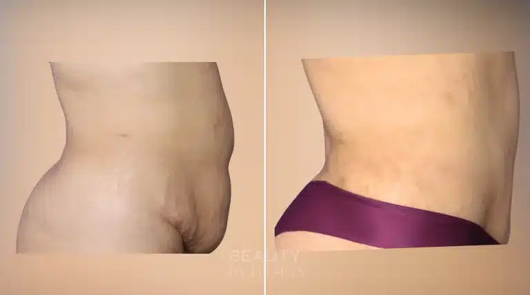 Liposuction body contouring before and after, side view &mdash; Patient 3