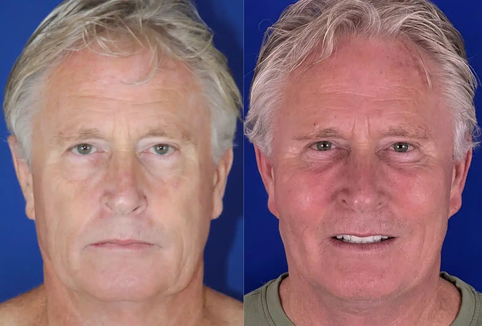 Cheek implant and facelift result, front view &mdash; Patient 5