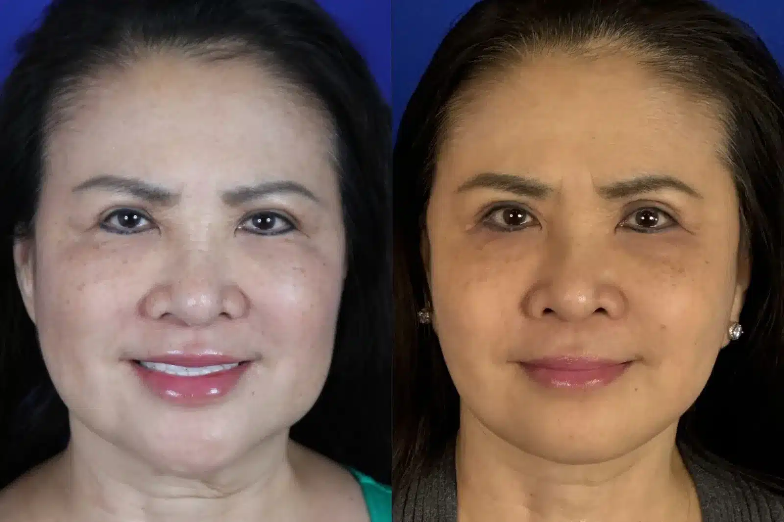 Facelift before & after, front view &mdash; Patient 6 &mdash; Facelift Results