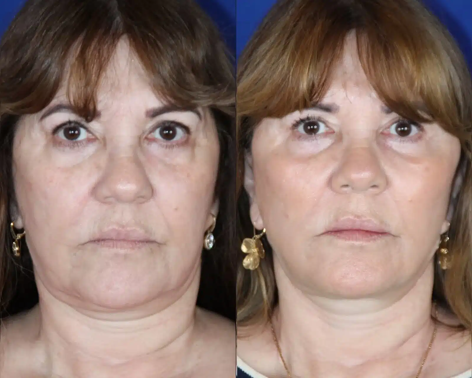 Facelift before & after, front view &mdash; Patient 5 &mdash; Facelift & Neck Lift
