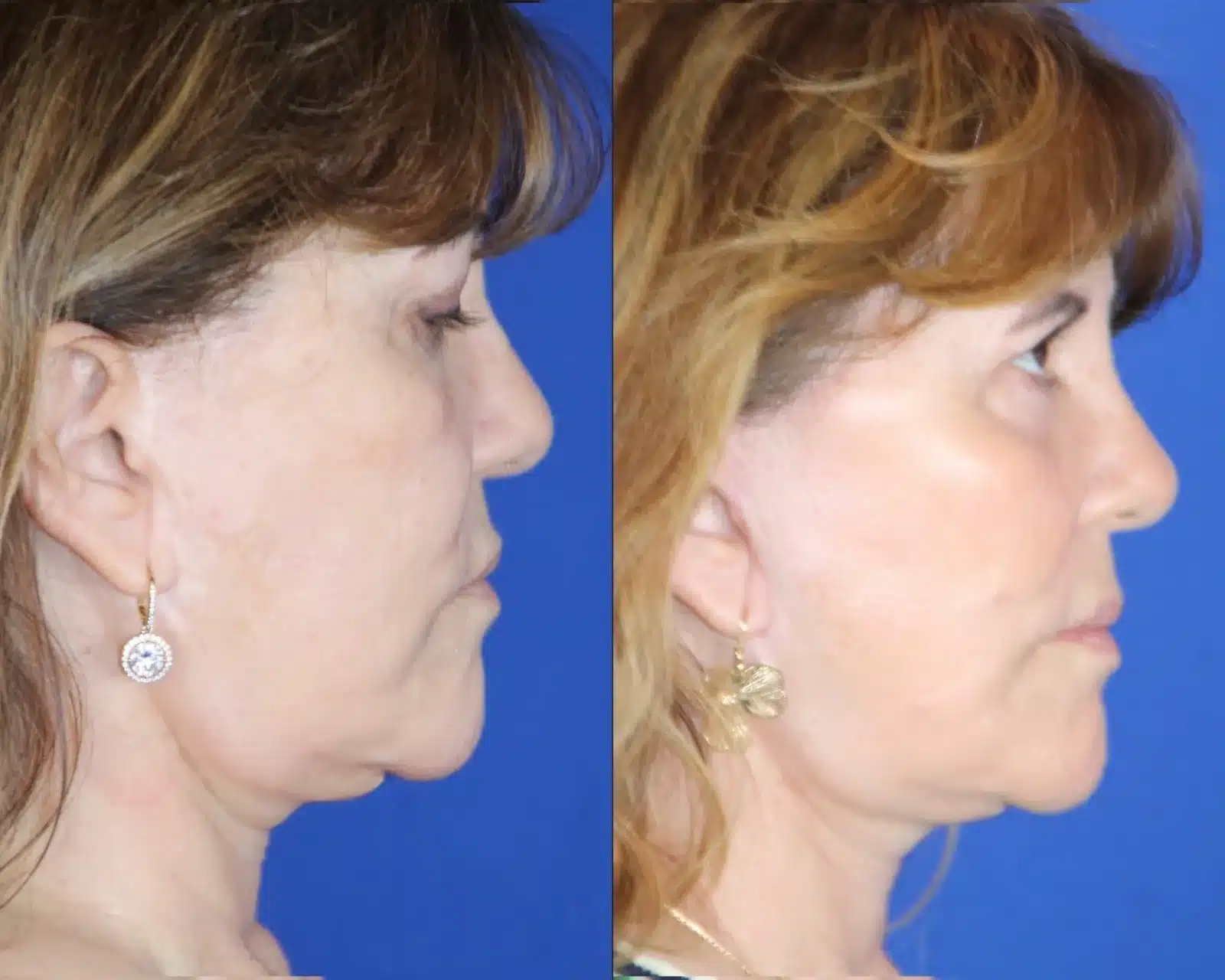 Facelift before & after, left profile &mdash; Patient 5 &mdash; Facelift & Neck Lift